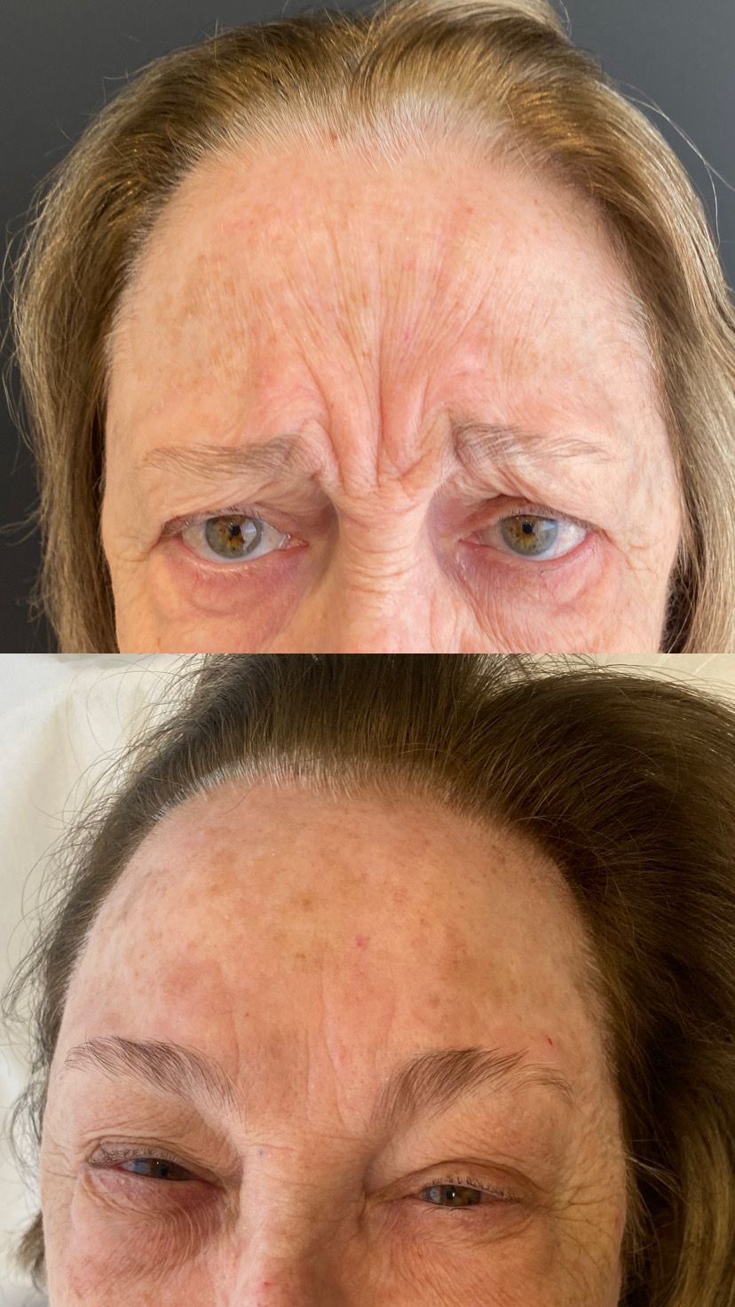 Antes e depois de Toxina botulínica — Glabela