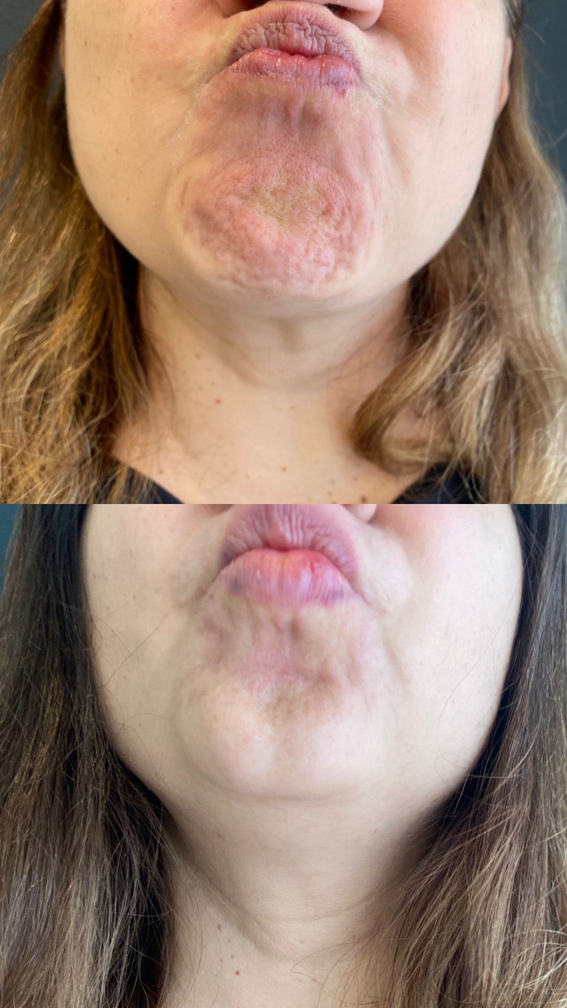 Antes e depois de Toxina botulínica — Queixo