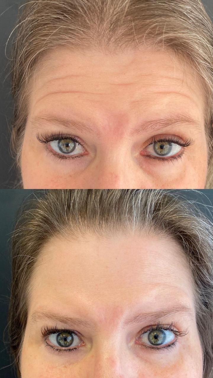 Antes e depois de Toxina botulínica — Testa