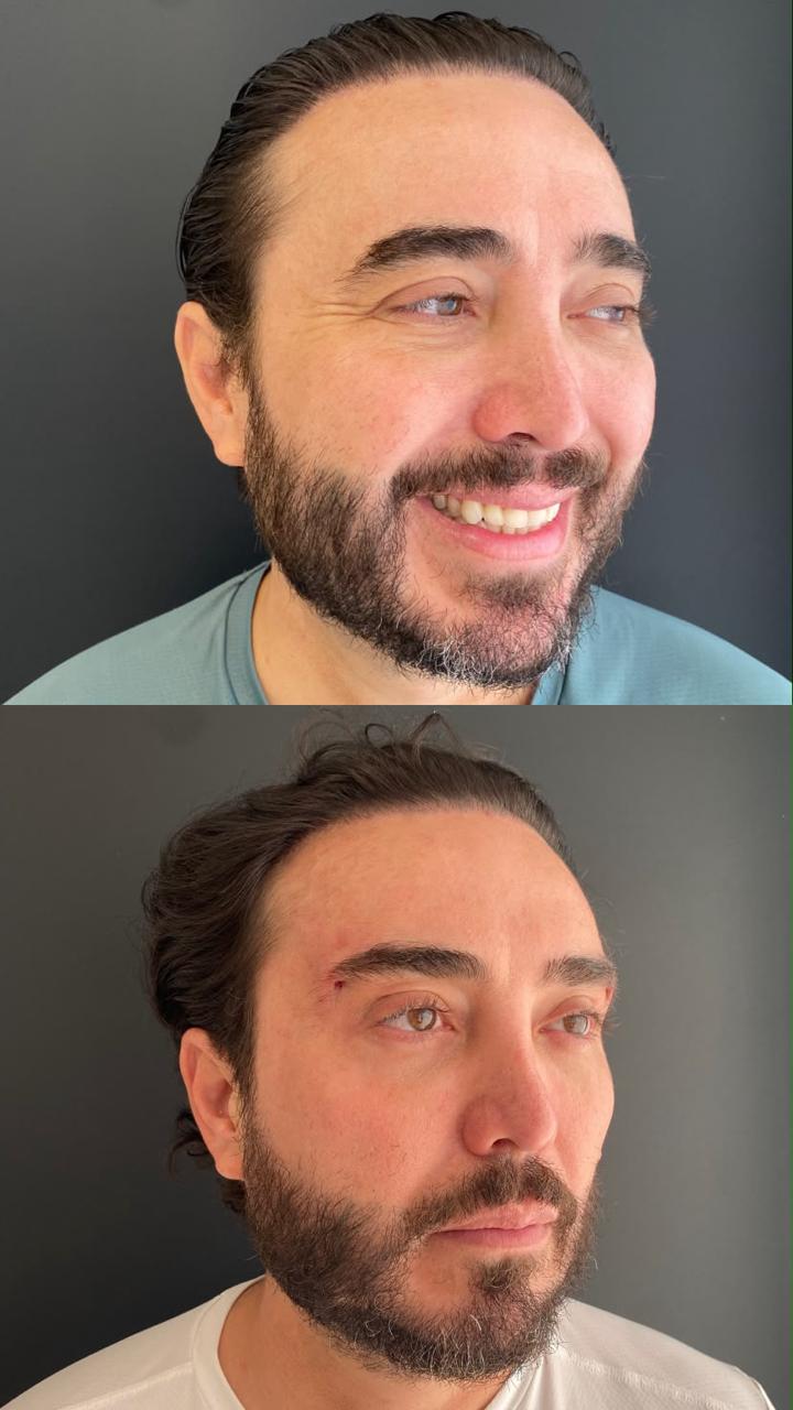 Antes e depois de Fios de PDO — Sustentação facial