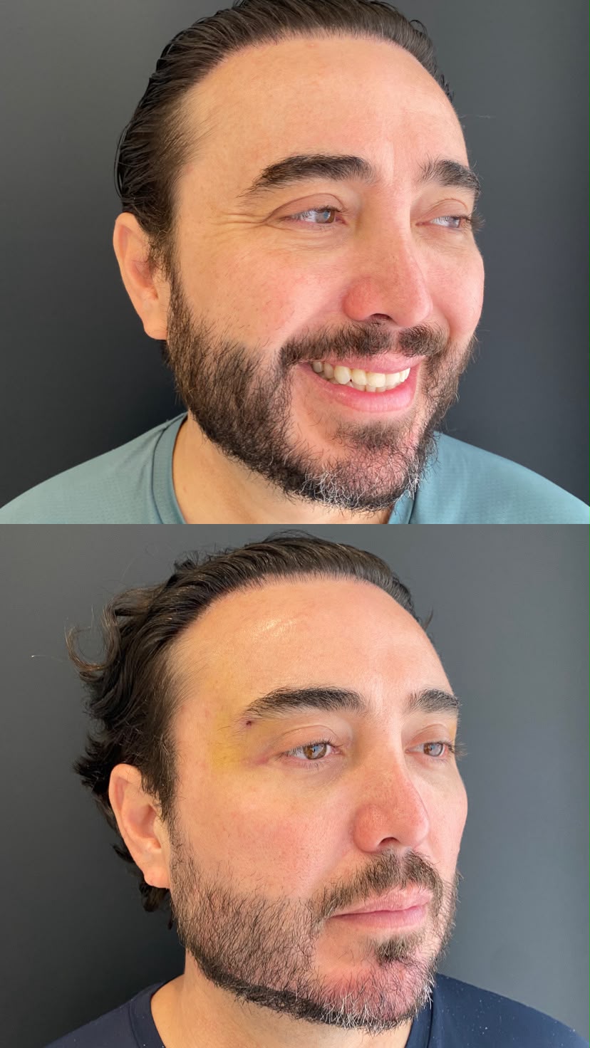 Antes e depois de Preenchimento — Contorno mandibular