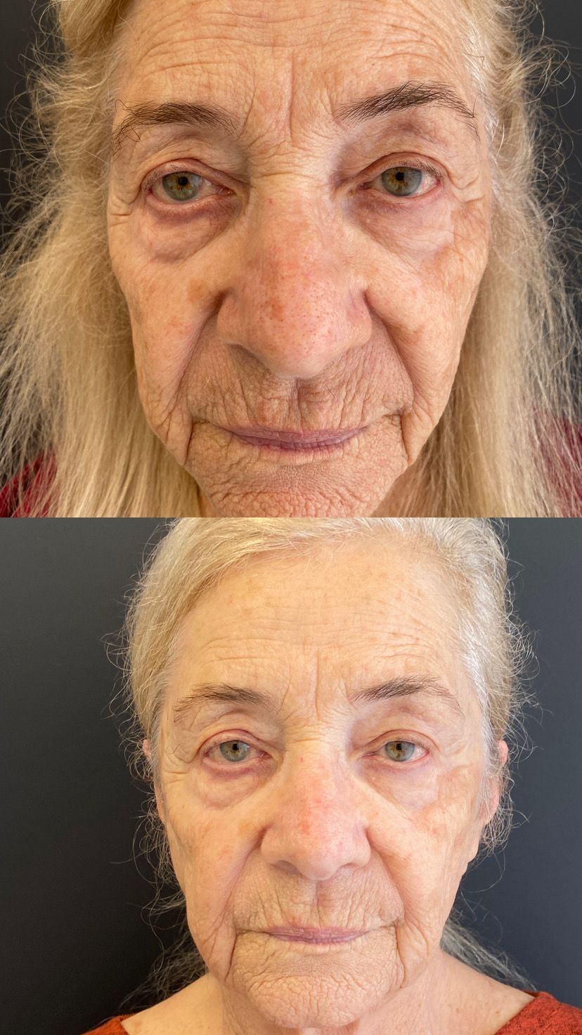 Antes e depois de Protocolo PEH3 — Cuidado facial