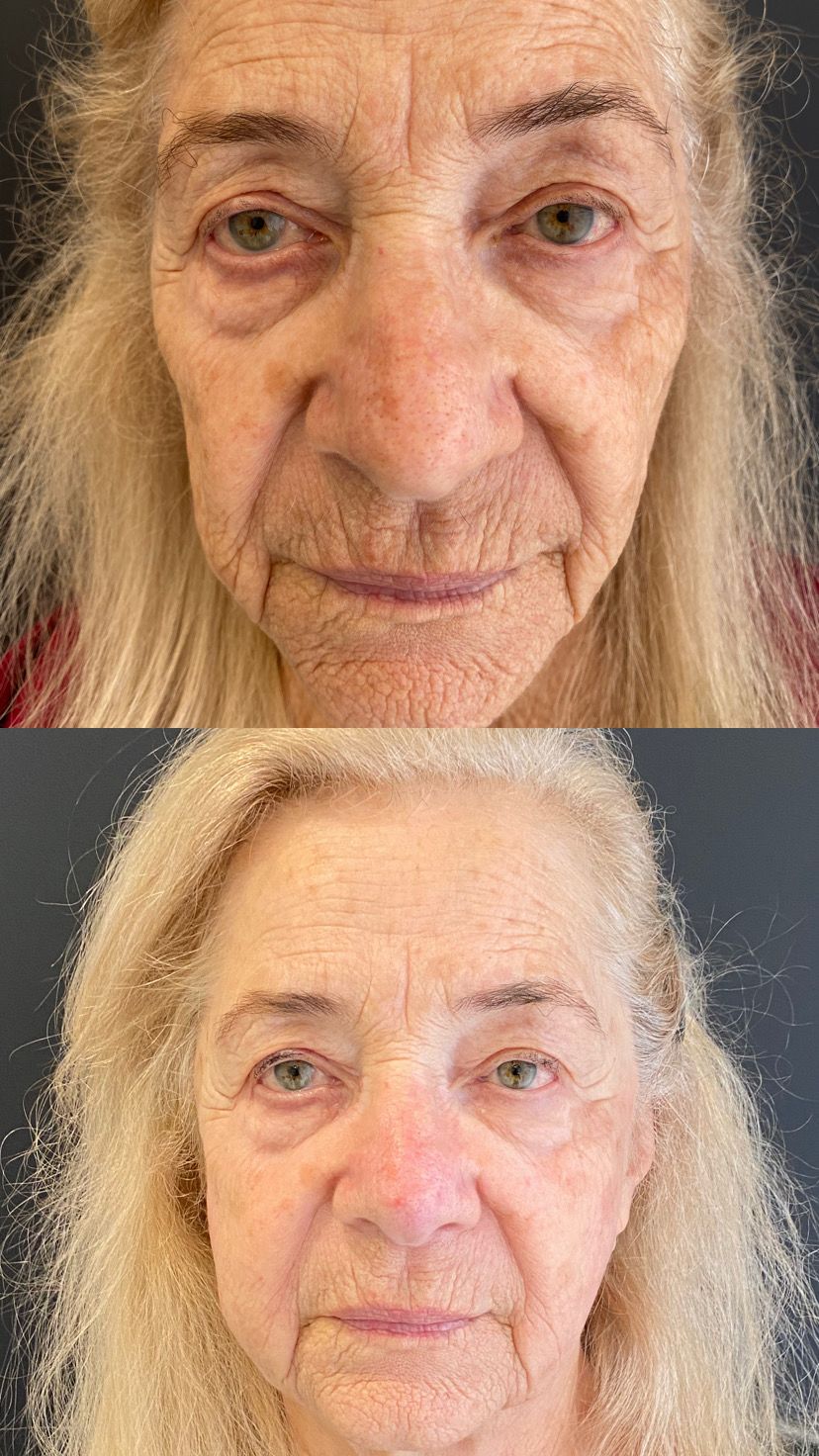 Antes e depois de Protocolo PEH3 — Rejuvenescimento