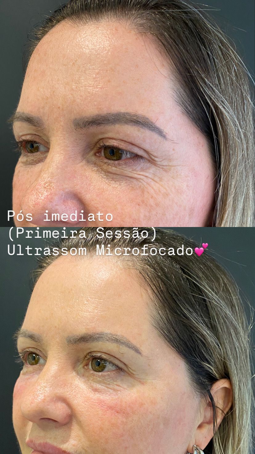 Antes e depois de Ultrassom microfocado — Região dos olhos