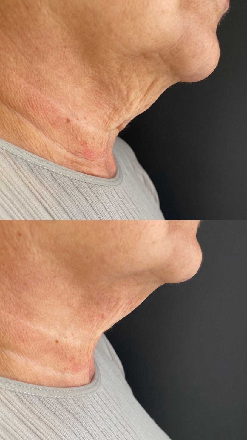 Antes e depois de Ultrassom microfocado — Papada e contorno